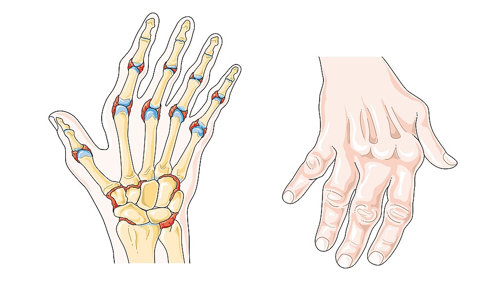 el tratamiento de la artritis