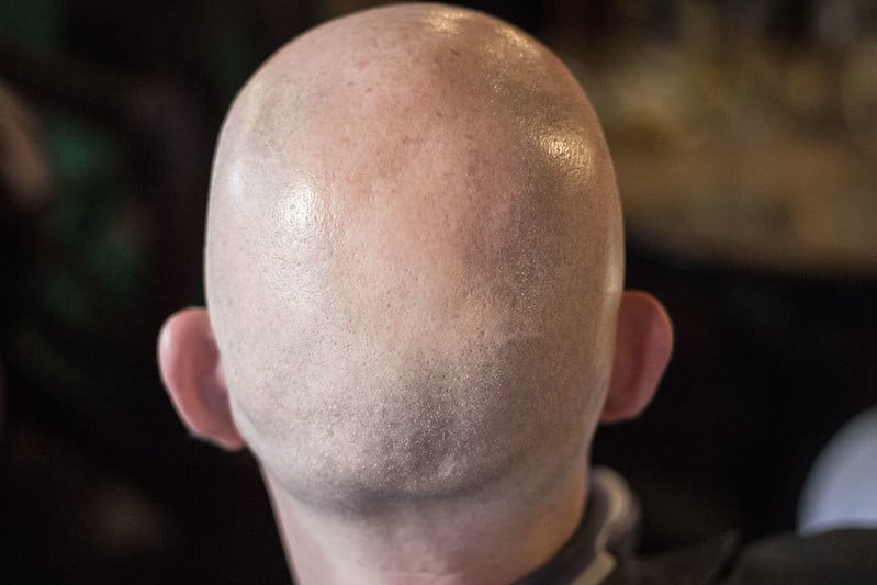 el extracto de cáñamo reduce la alopecia